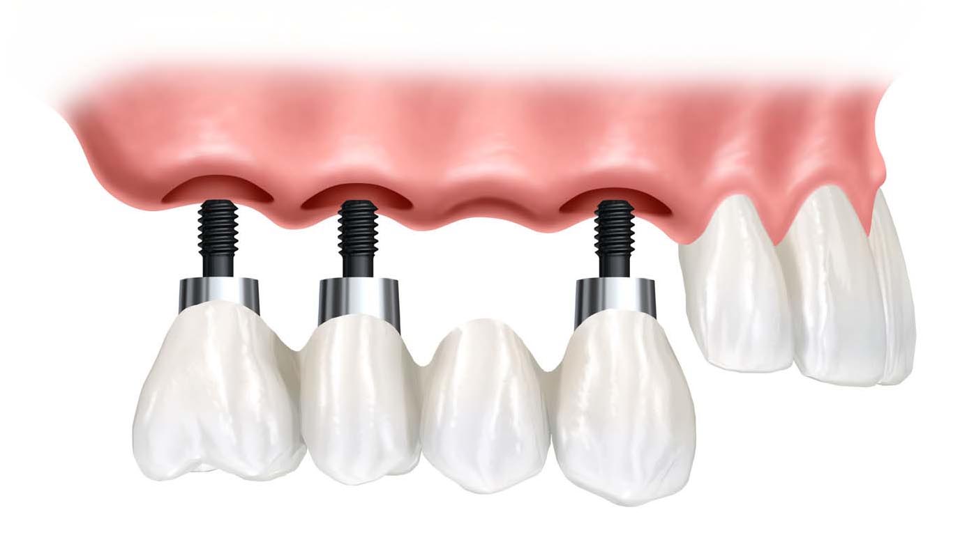 Cấy ghép Implant cho trường hợp mất nhiều răng