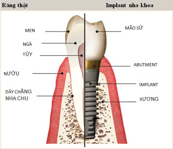 Trồng răng implant tại hải phòng uy tín