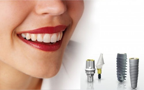 Đánh răng đúng cách sau khi cấy ghép implant