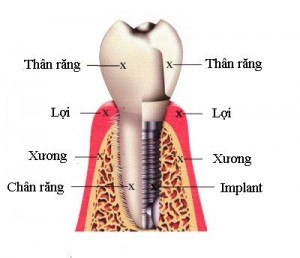 implant 