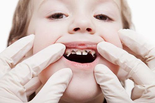 sâu răng sớm ở trẻ