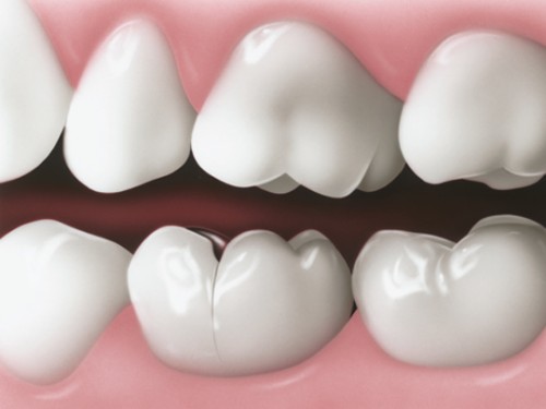 Nứt răng, nguyên nhân và cách điều trị