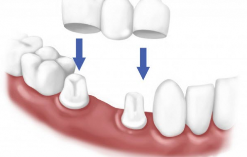 Phục hình răng sứ bằng phương pháp làm cầu răng