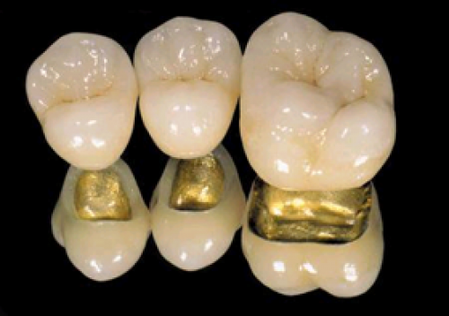 Đặc điểm răng sứ kim loại quý
