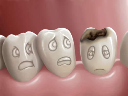 Các vấn đề về sâu răng